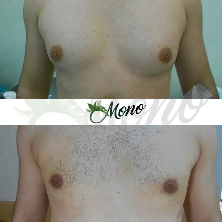 Gynecomastia