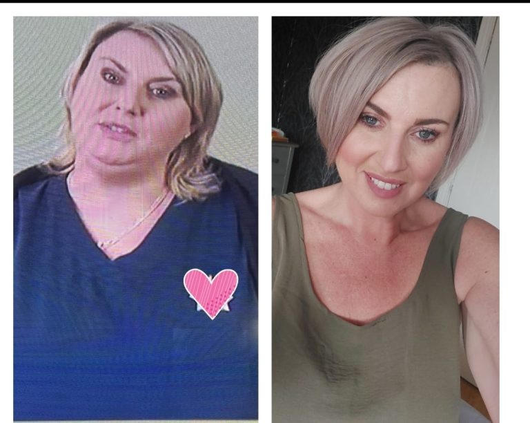 Gastric Bypass