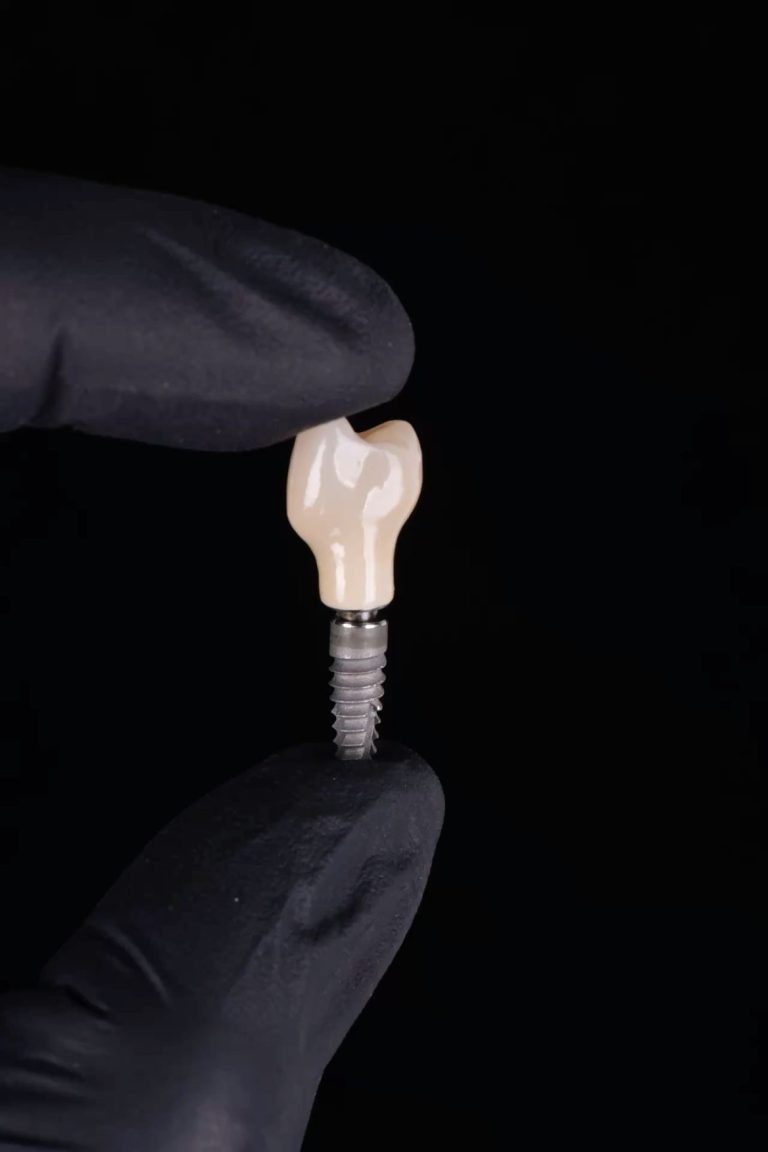 Dental Implants