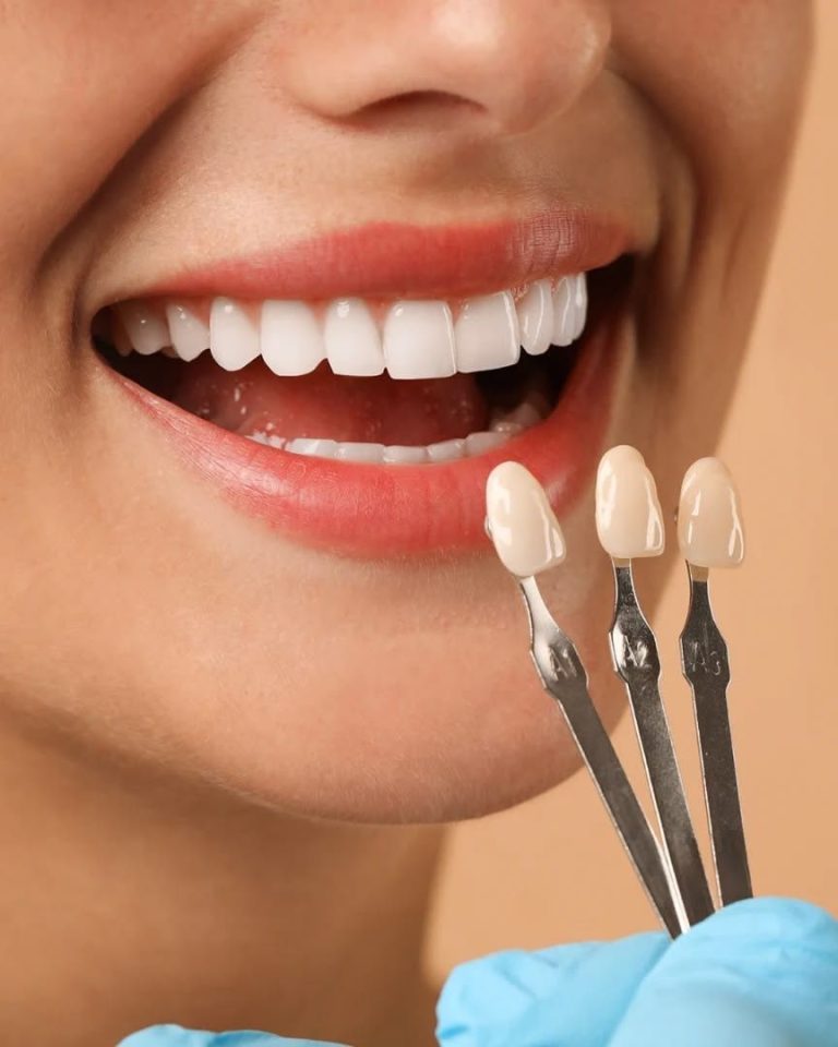 Dental Veneers