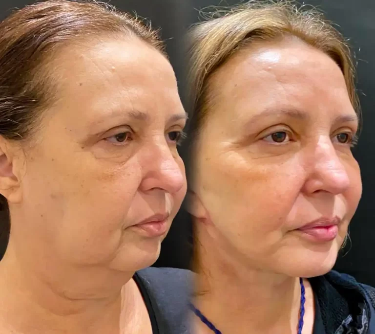 Face Lift Turkey
