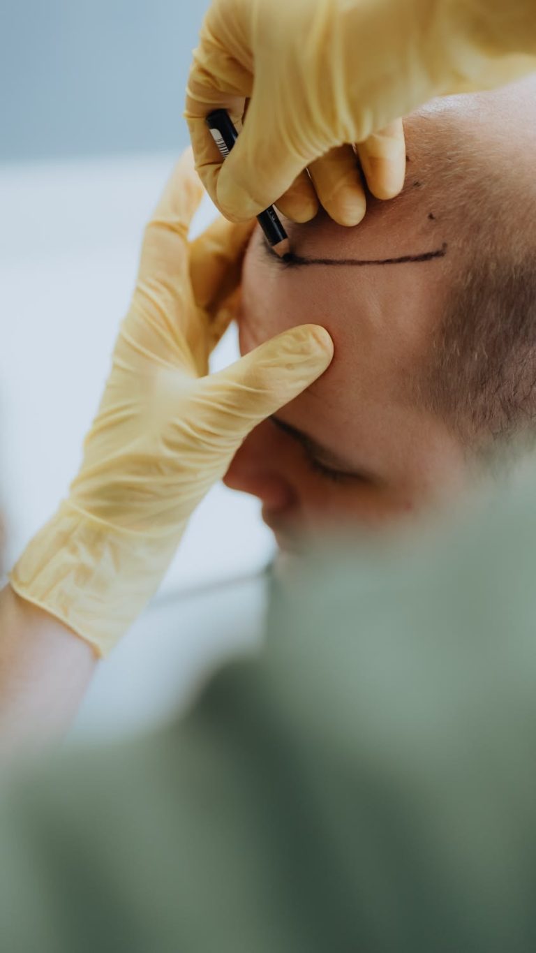 Hair Transplant
