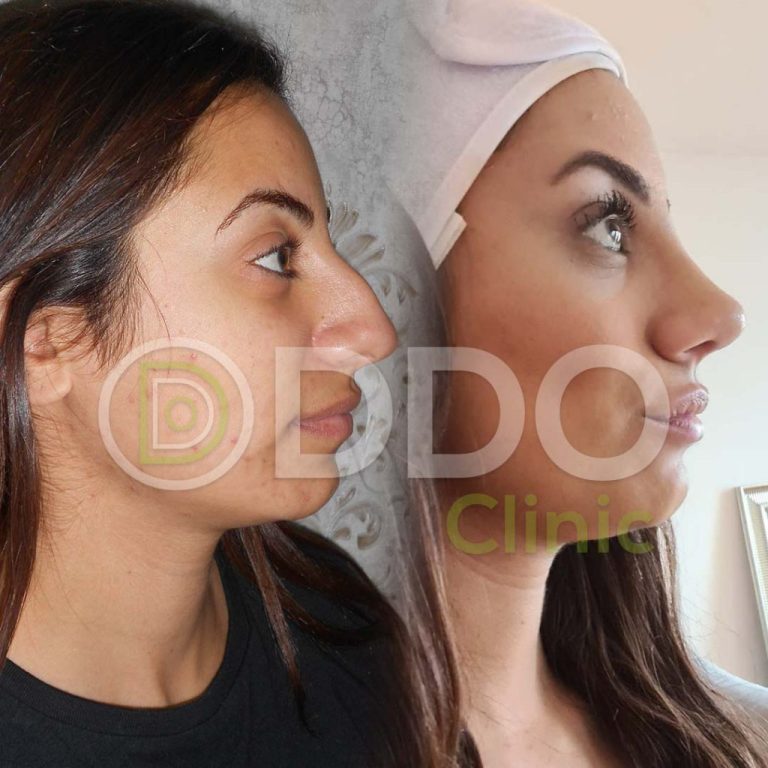 Rhinoplasty Turkey